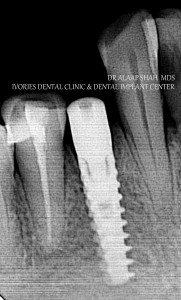 POST OP XRAY DURING MODULE   